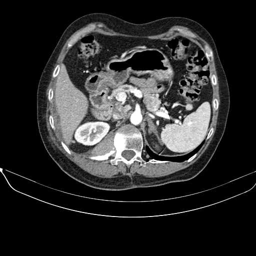 File:Acquired adrenal hyperplasia - due to thymic carcinoid tumor (Radiopaedia 21269-21184 C+ arterial phase 34).jpg