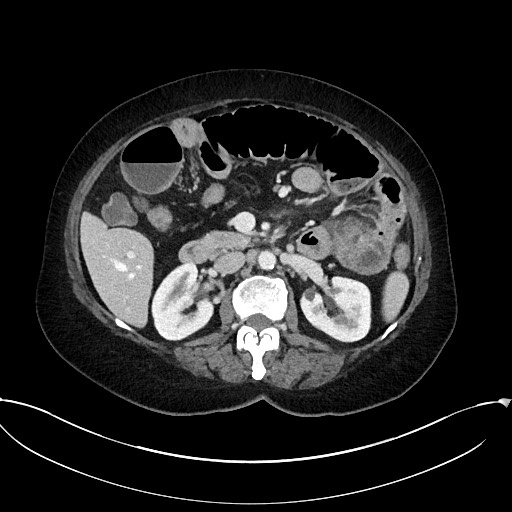 Active Crohn disease (Radiopaedia 59394-66750 Axial C+ portal venous phase 29).jpg