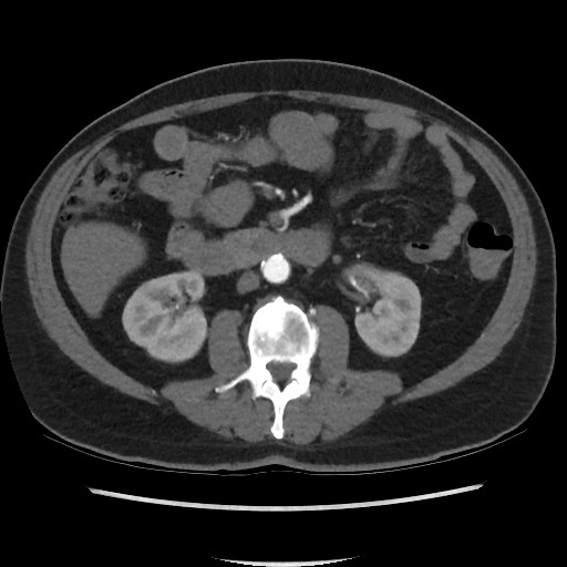 Active colonic bleed on CT (Radiopaedia 49765-55025 Axial C+ arterial phase 38).jpg