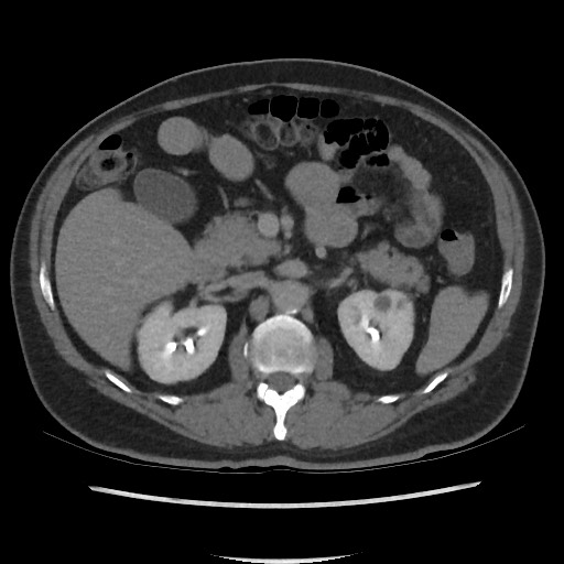 File:Active colonic bleed on CT (Radiopaedia 49765-55025 Axial C+ delayed 30).jpg