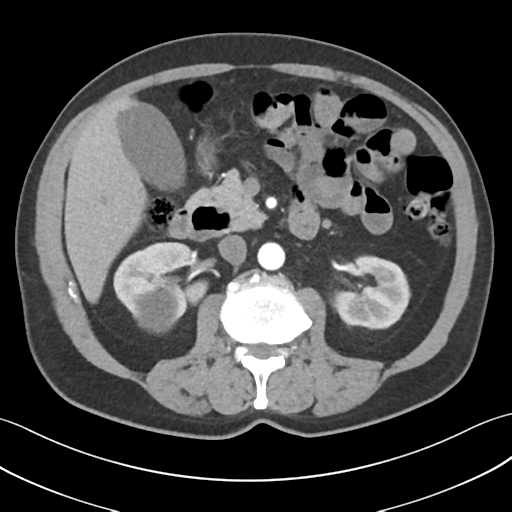 File:Active diverticular hemorrhage (Radiopaedia 39415-41725 Axial C+ arterial phase 26).png