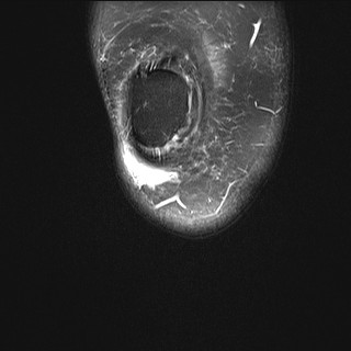 File:Acute-on-chronic transient lateral patellar dislocation with trochlear dysplasia (Radiopaedia 84099-99349 Coronal PD fat sat 36).jpg
