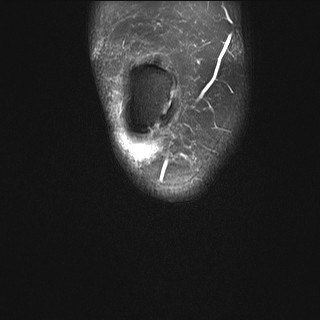 File:Acute-on-chronic transient lateral patellar dislocation with trochlear dysplasia (Radiopaedia 84099-99349 Coronal PD fat sat 37).jpg