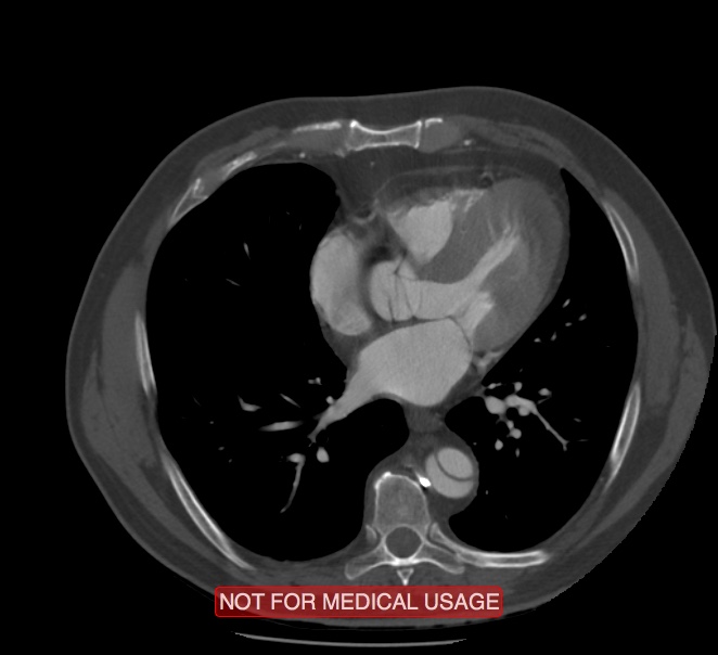 Acute aortic dissection - Stanford type A (Radiopaedia 40661-43285 Axial C+ arterial phase 43).jpg
