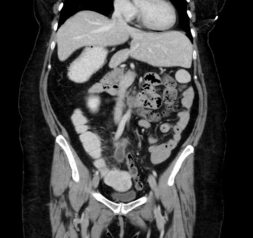 Acute appendicitis, heterotaxy syndrome (Radiopaedia 66884-76202 Coronal C+ portal venous phase 55).jpg