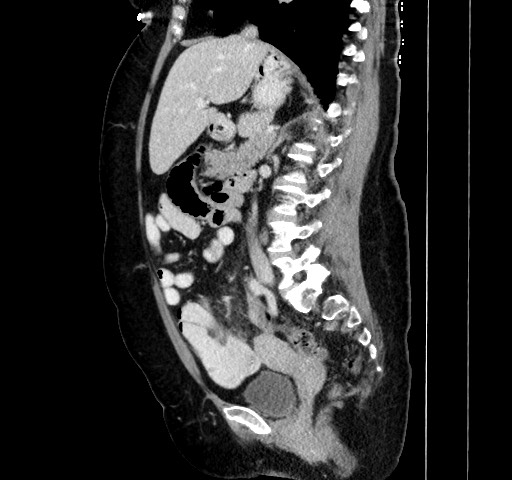 File:Acute appendicitis, heterotaxy syndrome (Radiopaedia 66884-76202 Sagittal C+ portal venous phase 62).jpg