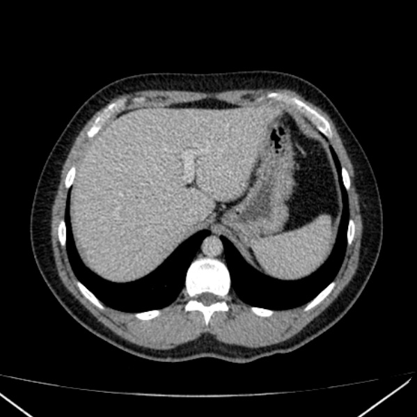 Acute appendicitis (Radiopaedia 38255-40270 Axial C+ portal venous phase 16).jpg