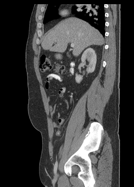 Acute appendicitis (Radiopaedia 48511-53463 Sagittal C+ portal venous phase 52).jpg