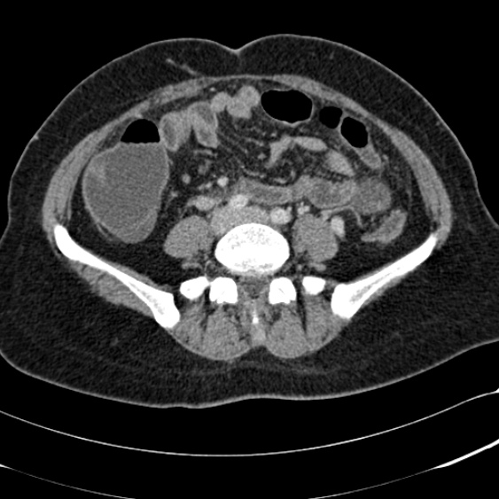 File:Acute appendicitis (Radiopaedia 48792-53822 Axial C+ portal venous phase 73).jpg