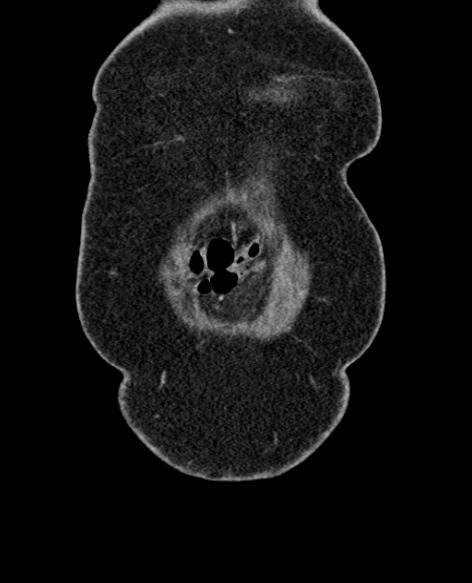 File:Acute appendicitis (Radiopaedia 48792-53822 Coronal C+ portal venous phase 17).jpg
