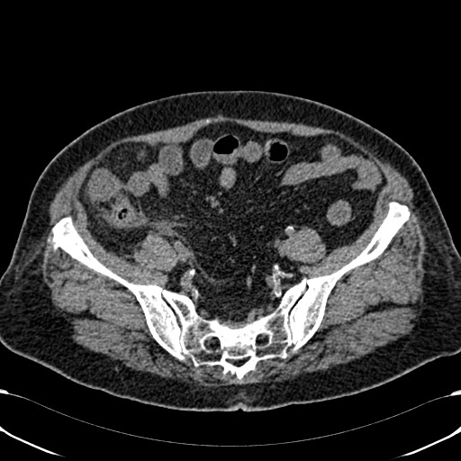 Acute appendicitis (Radiopaedia 58627-65818 Axial non-contrast 67).jpg