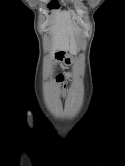 Acute appendicitis (Radiopaedia 62608-70901 Coronal C+ portal venous phase 2).jpg