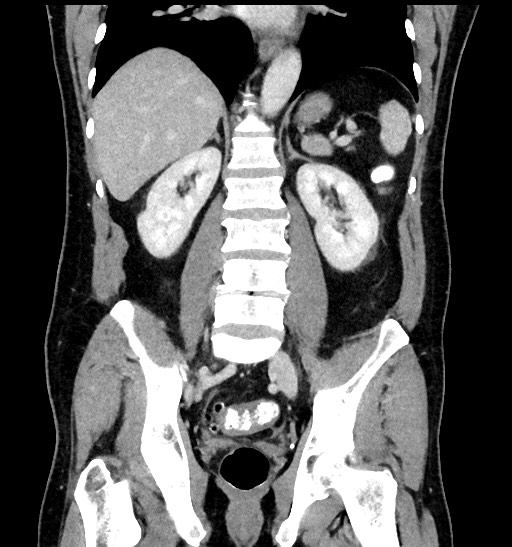 Acute appendicitis (Radiopaedia 77016-88960 Coronal C+ portal venous phase 64).jpg