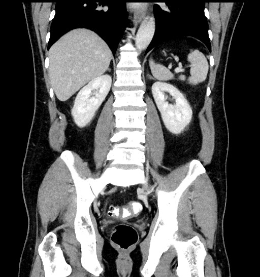 File:Acute appendicitis (Radiopaedia 77016-88960 Coronal C+ portal venous phase 66).jpg