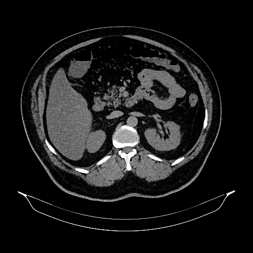 File:Acute appendicitis (Radiopaedia 79950-93224 Axial non-contrast 38).jpg