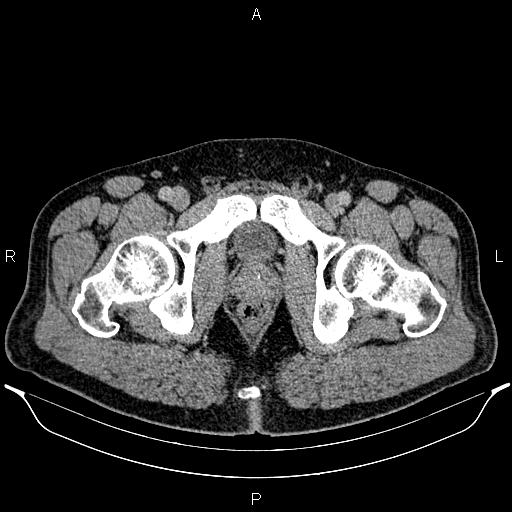 Acute appendicitis (Radiopaedia 84780-100240 Axial C+ portal venous phase 110).jpg