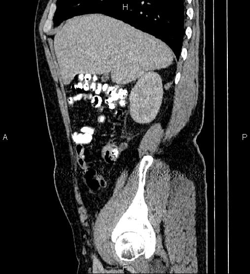 Acute appendicitis (Radiopaedia 84780-100240 Sagittal C+ portal venous phase 25).jpg