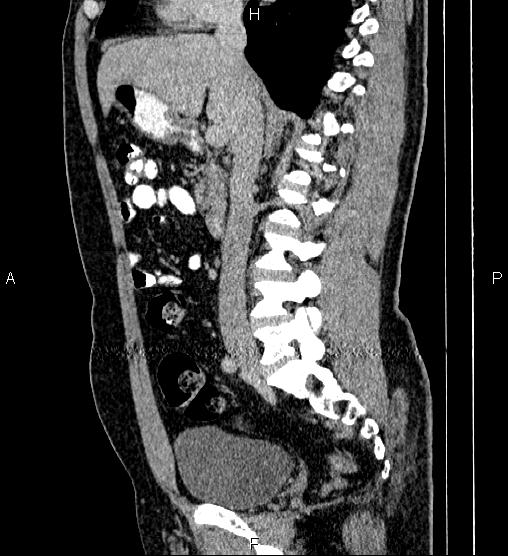Acute appendicitis (Radiopaedia 84780-100240 Sagittal C+ portal venous phase 45).jpg
