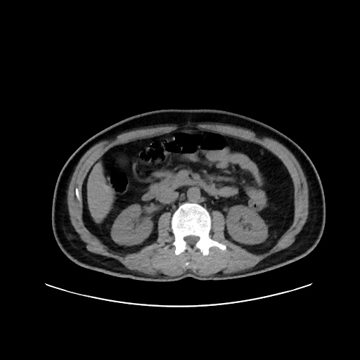 File:Acute appendicitis and COVID 19 pneumonia (Radiopaedia 76604-88380 Axial non-contrast 70).jpg