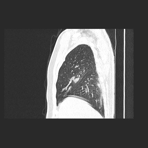 File:Acute appendicitis and COVID 19 pneumonia (Radiopaedia 76604-88380 Sagittal lung window 22).jpg