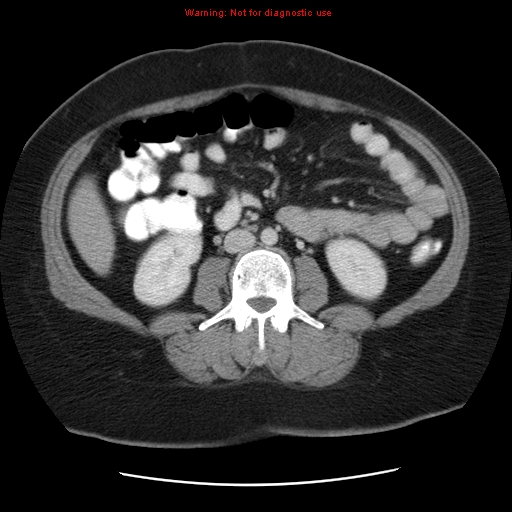 File:Acute appendicitis complicated by ovarian vein thrombophlebitis (Radiopaedia 16172-15851 Axial C+ portal venous phase 50).jpg