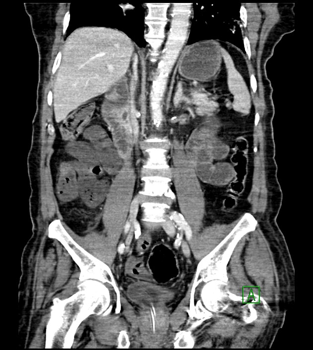 Acute arterial mesenteric ischemia (Radiopaedia 78238-90828 Coronal C+ portal venous phase 56).jpg
