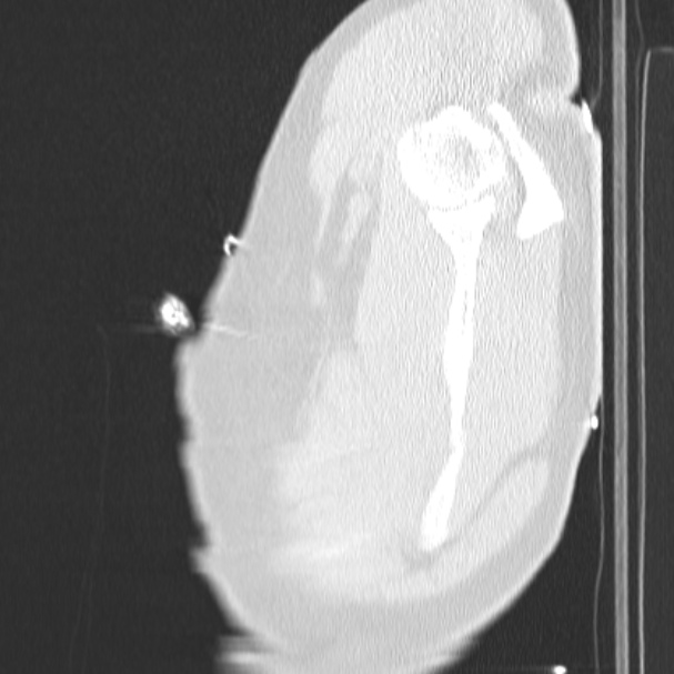 Acute aspiration pneumonitis (Radiopaedia 33605-34703 Sagittal lung window 85).jpg