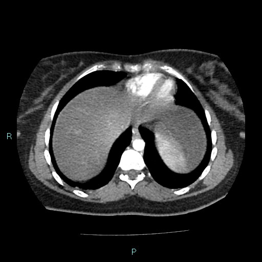 File:Acute bilateral pyelonephritis (Radiopaedia 37146-38881 Axial C+ arterial phase 11).jpg