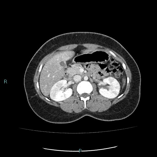 Acute bilateral pyelonephritis (Radiopaedia 37146-38881 Axial C+ portal venous phase 42).jpg