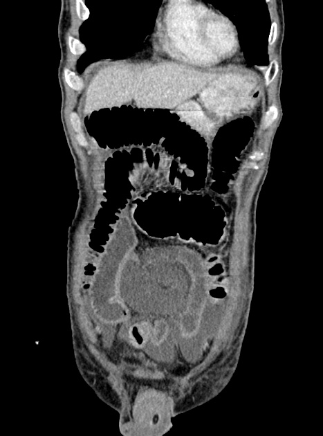 Acute bowel ischemia (Radiopaedia 87695-104114 Coronal C+ portal venous phase 110).jpg