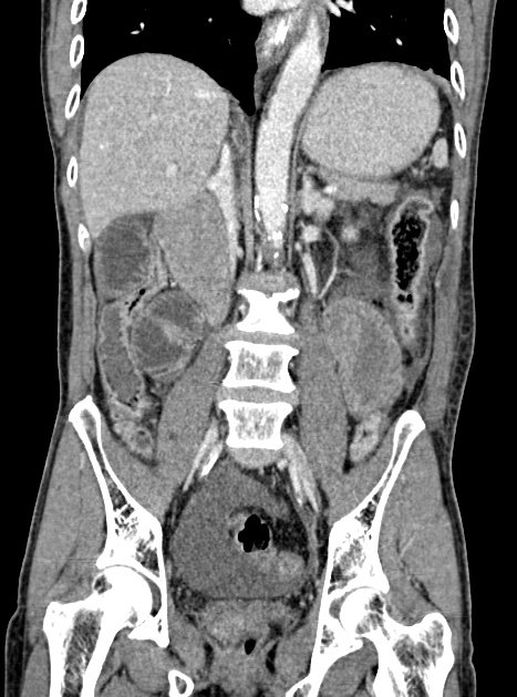 Acute bowel ischemia (Radiopaedia 87695-104114 Coronal C+ portal venous phase 229).jpg