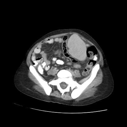 Acute calculous cholecystitis in patient with osteopetrosis (Radiopaedia 77871-90159 Axial C+ portal venous phase 58).jpg