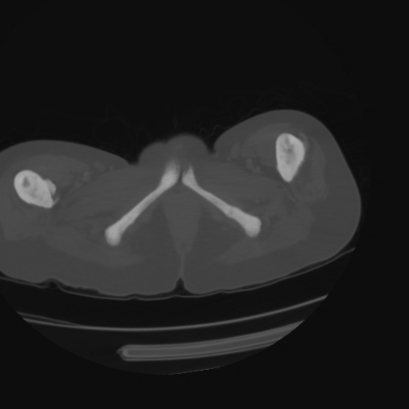 File:Acute calculous cholecystitis in patient with osteopetrosis (Radiopaedia 77871-90159 Axial bone window 55).jpg