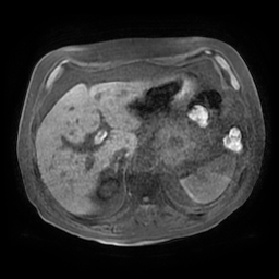 File:Acute cholecystitis complicated by pylephlebitis (Radiopaedia 65782-74915 Axial T1 fat sat 37).jpg