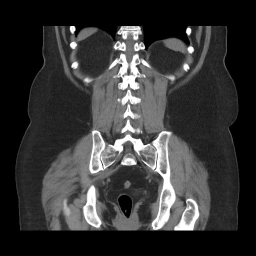 Acute cholecystitis with tensile fundus sign (Radiopaedia 71394-81723 Coronal non-contrast 92).jpg