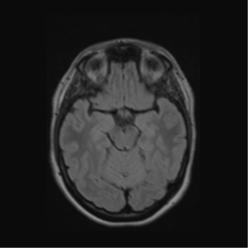 Acute disseminated encephalomyelitis (ADEM) (Radiopaedia 38073-40065 Axial FLAIR 23).png