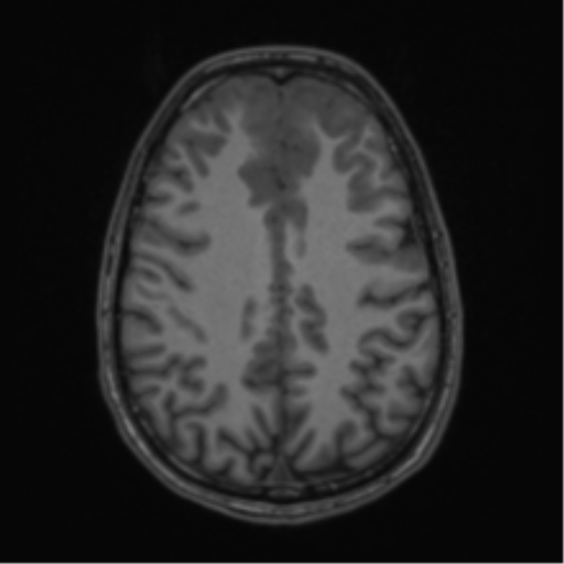 Acute disseminated encephalomyelitis (ADEM) (Radiopaedia 65319-74349 Axial T1 47).png