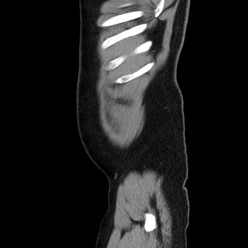 Acute diverticulitis with localized perforation (Radiopaedia 41296-44113 Sagittal C+ portal venous phase 12).jpg