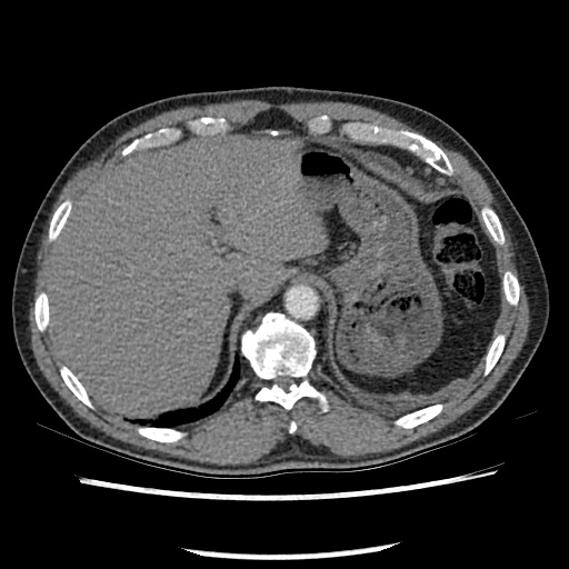 Acute epicardial fat necrosis (Radiopaedia 42327-45440 Axial C+ CTPA 83).jpg