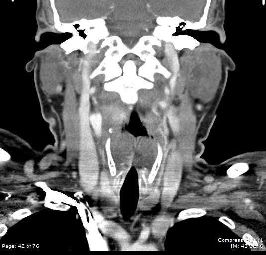 Acute epiglottitis (Radiopaedia 54375-60590 Coronal C+ arterial phase 42).jpg