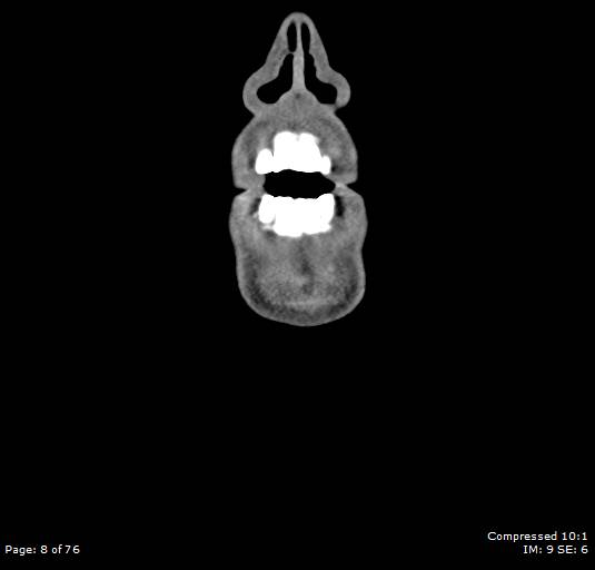 Acute epiglottitis (Radiopaedia 54375-60590 Coronal C+ arterial phase 8).jpg