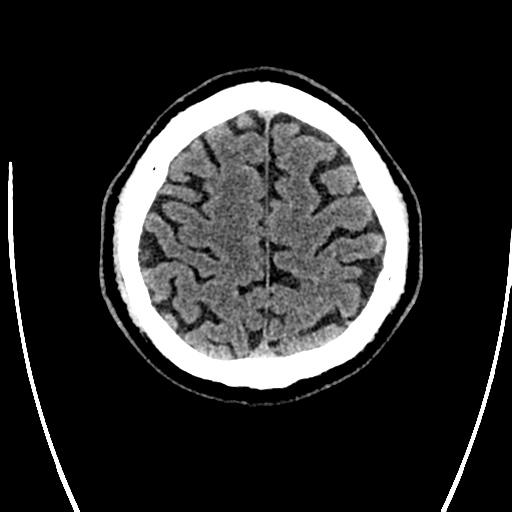 Acute left middle cerebral artery territory ischemic stroke (Radiopaedia 35688-37223 Axial non-contrast 70).png