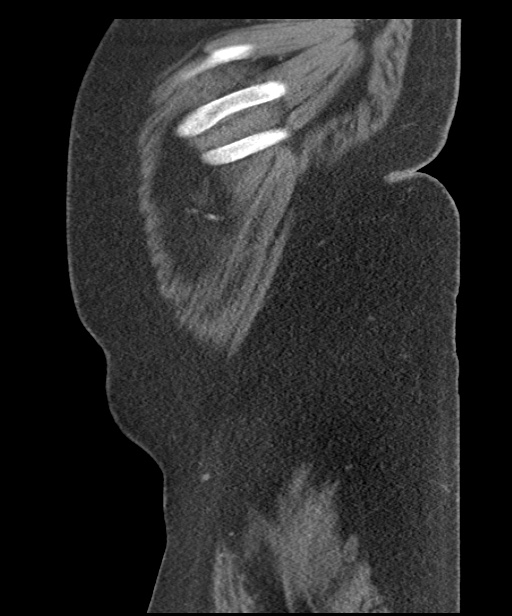 Acute mesenteric venous ischemia (Radiopaedia 46041-50383 Sagittal C+ portal venous phase 114).jpg