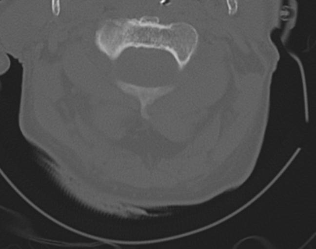 Acute on chronic subdural hematoma and thoracic vertebral injury in a multitrauma patient (Radiopaedia 31698-32619 Axial bone window 17).jpg