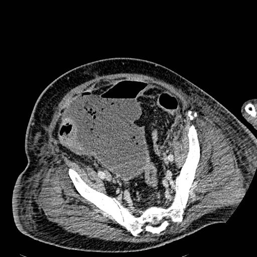 Acute pancreatic necrosis (Radiopaedia 13560-18501 Axial C+ portal venous phase 121).jpg