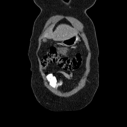File:Acute pancreatitis (Radiopaedia 20829-20744 Coronal C+ portal venous phase 8).jpg