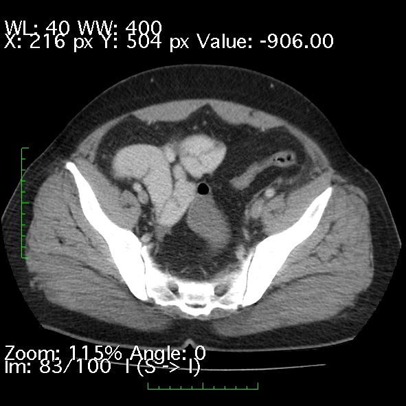Acute pancreatitis (Radiopaedia 34043-35276 Axial C+ portal venous phase 83).jpg