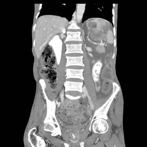 File:Acute pancreatitis (Radiopaedia 50213-55558 Coronal C+ portal venous phase 27).jpg