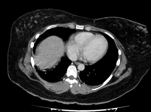 Acute pancreatitis (Radiopaedia 69236-79012 Axial C+ portal venous phase 8).jpg