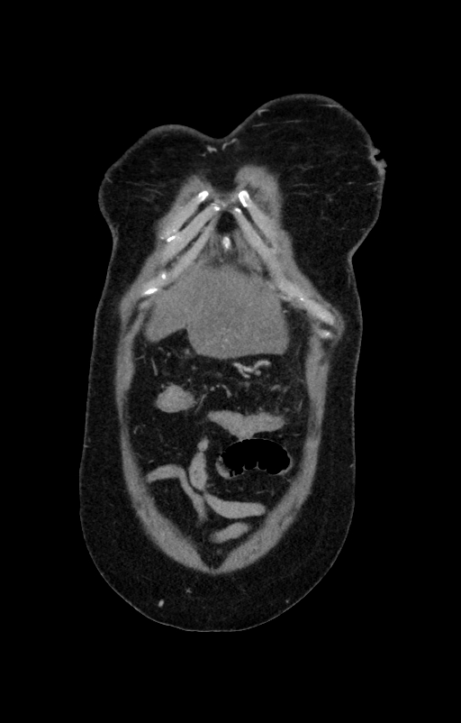 Acute pancreatitis (Radiopaedia 80007-93285 Coronal C+ portal venous phase 6).jpg